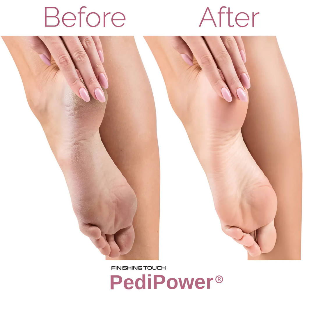 Pedi Power®️ Pro Electric Callus Remover